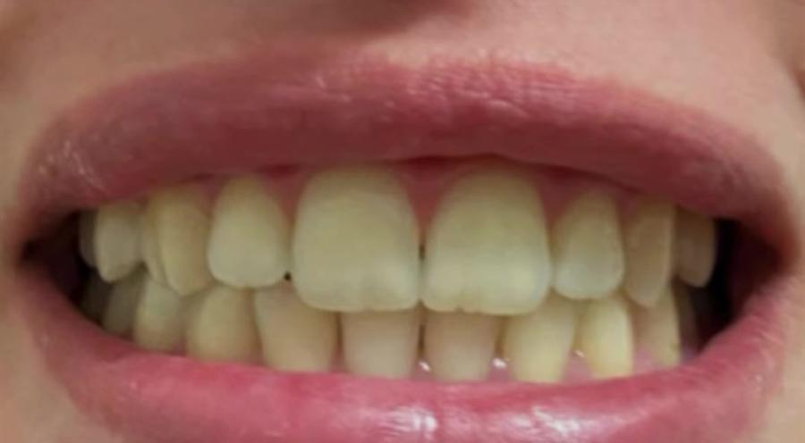 Antes do clareamento dental, com os dentes em tonalidade mais amarelada