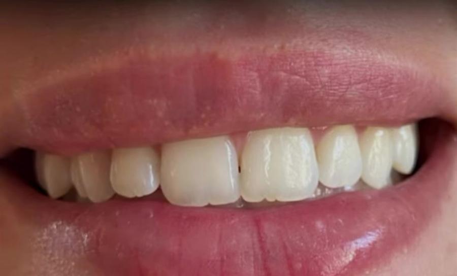 Depois do clareamento dental, com os dentes visivelmente mais claros