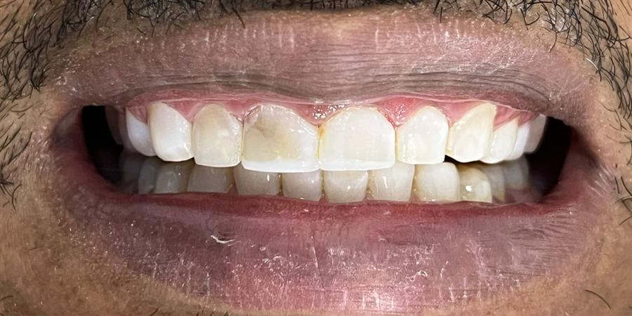 Antes do tratamento com facetas em resina