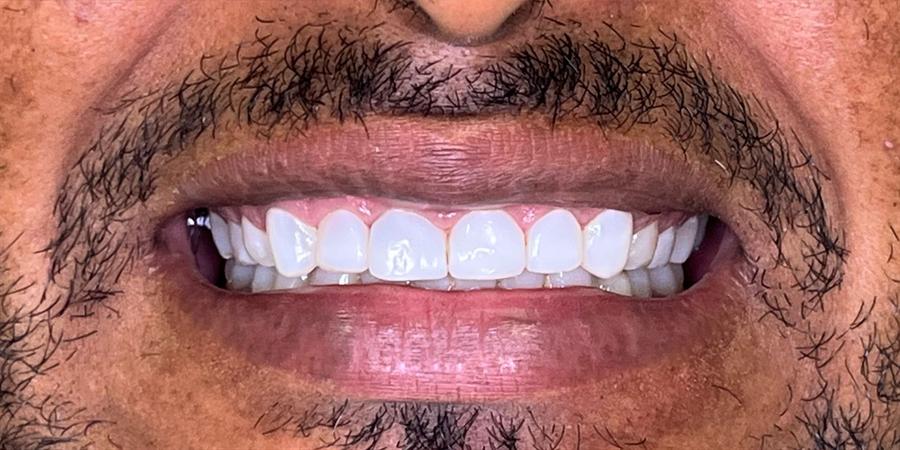 Depois do tratamento com facetas em resina