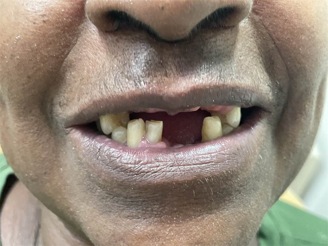 Antes do tratamento com implantes dentários, com perdas dentárias extensas