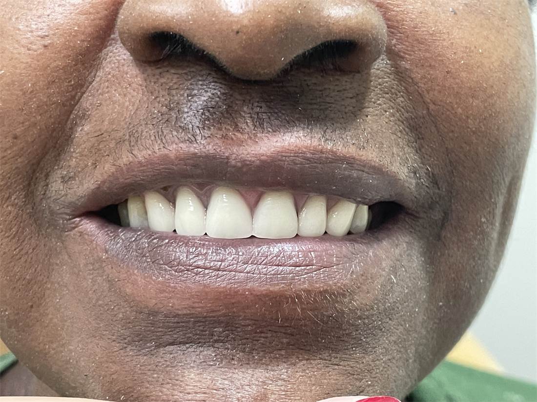 Depois do tratamento com implantes dentários, com o sorriso reabilitado